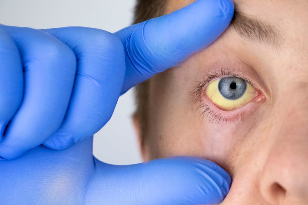 Yellow eyes: what causes?  When to consult?